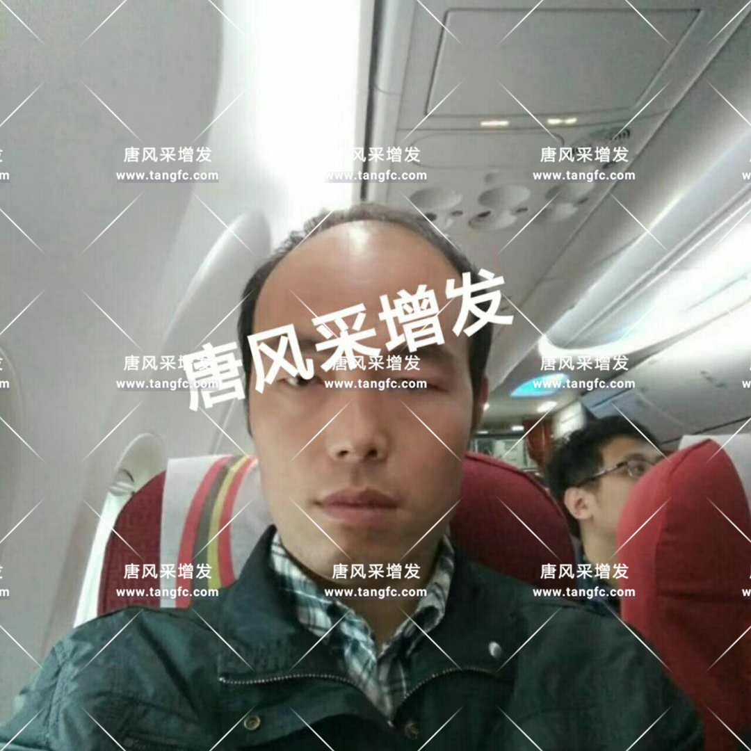 頭發(fā)稀疏 老天對年輕人開了一個(gè)很大的玩笑!