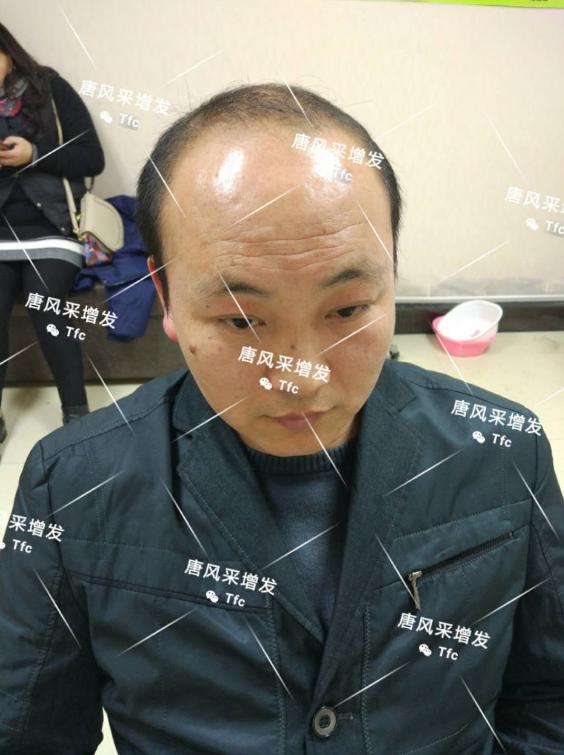 增發 人民公仆也脫發,廈門夏先生增發記