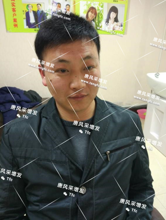 增發 人民公仆也脫發,廈門夏先生增發記