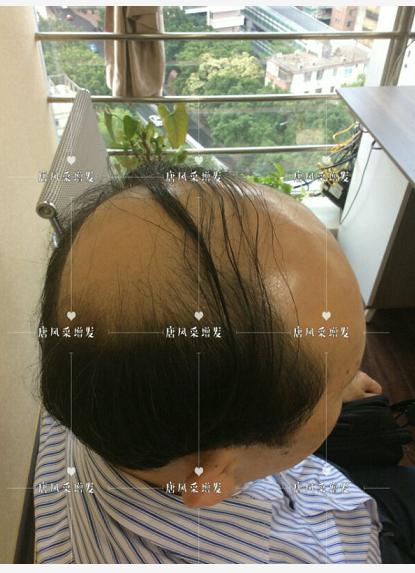 存款重要還是頭發(fā)重要 存款重要還是頭發(fā)重要?聽聽李先生怎么說!