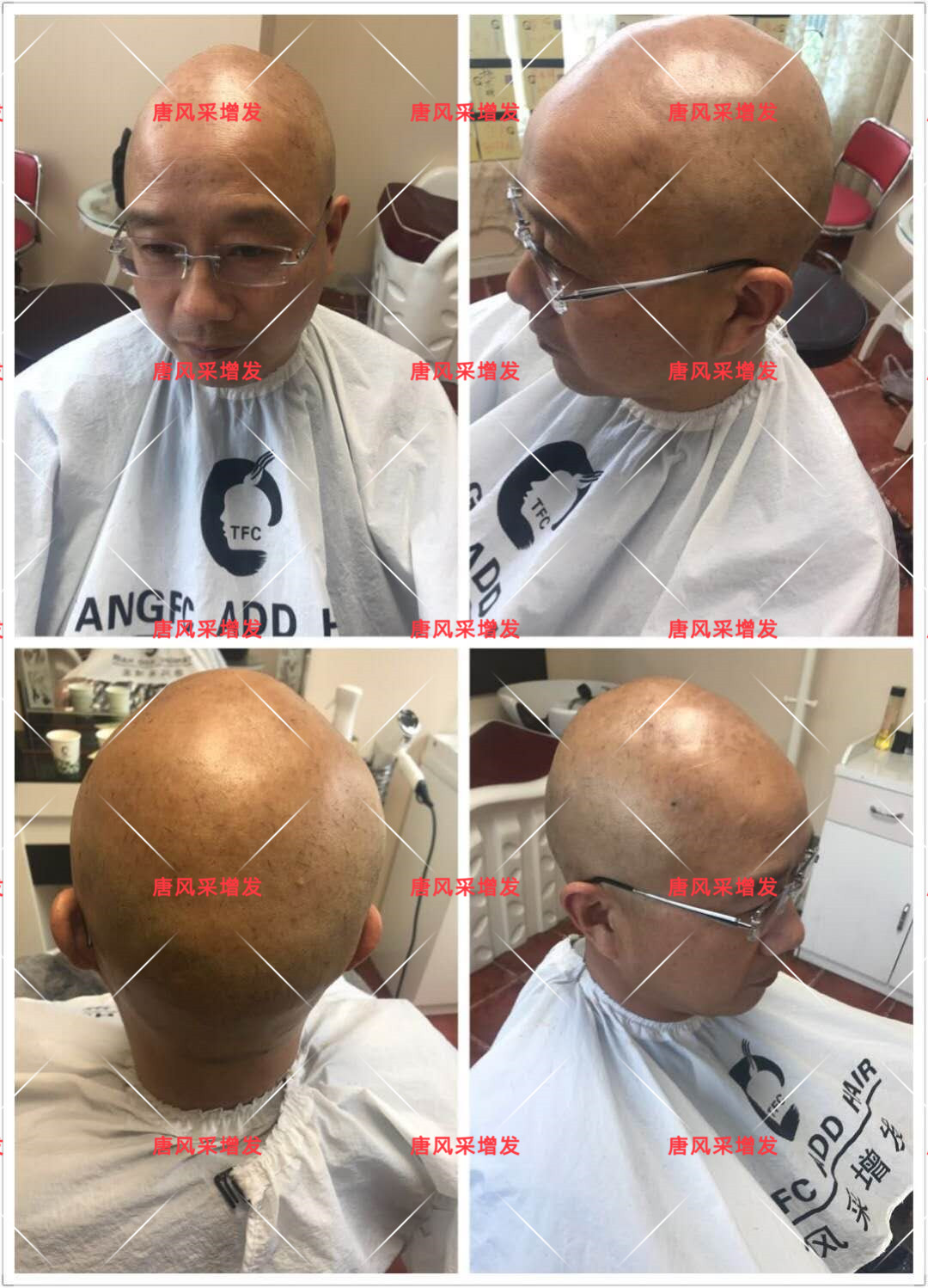 10年脫發(fā)困擾，一次性解決，唐風(fēng)采助力查先生“夢(mèng)想成真”