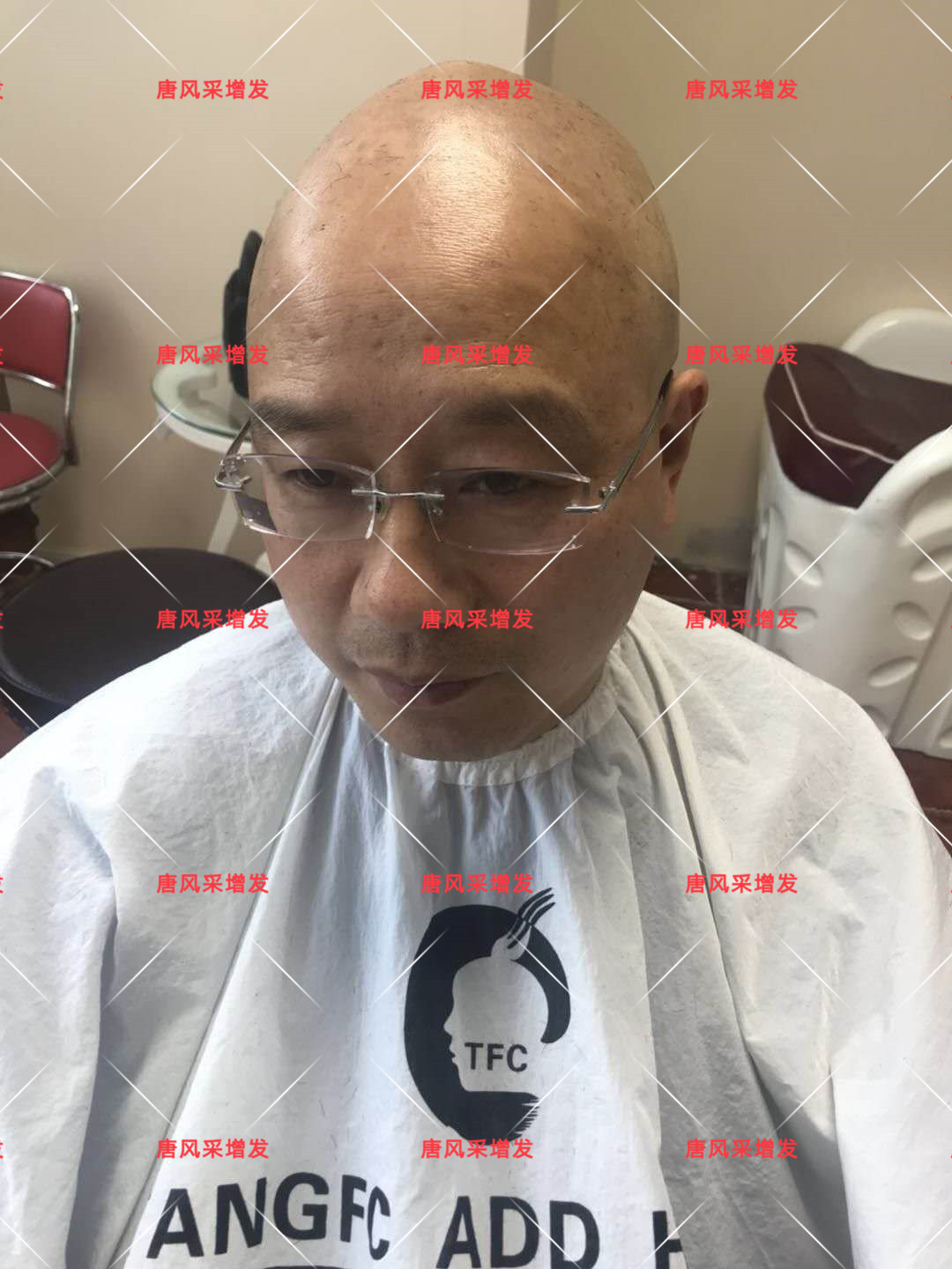 10年脫發(fā)困擾，一次性解決，唐風(fēng)采助力查先生“夢(mèng)想成真”