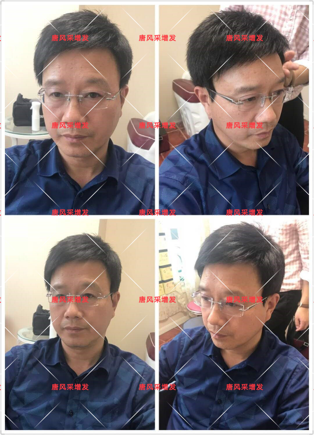 10年脫發(fā)困擾，一次性解決，唐風(fēng)采助力查先生“夢(mèng)想成真”