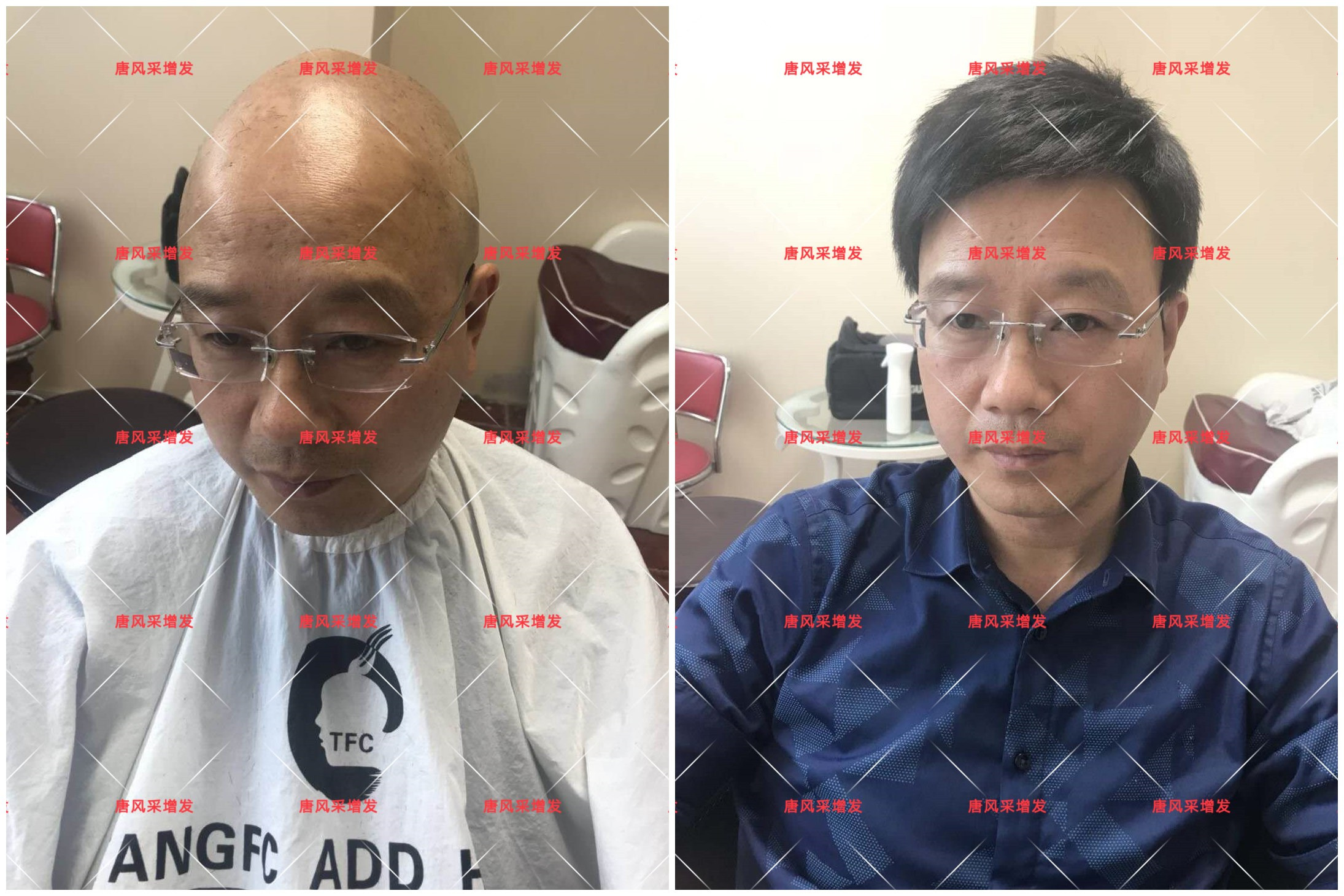 10年脫發(fā)困擾，一次性解決，唐風(fēng)采助力查先生“夢(mèng)想成真”