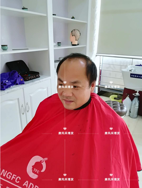 脫發 唐風采增發 脫發不分地域,唐風采增發助力北京爺們