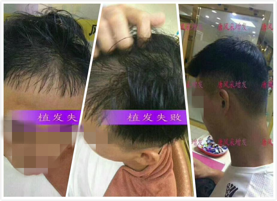 脫發(fā) 開始脫發(fā)的朋友上醫(yī)院,見到專家后他徹底絕望了!