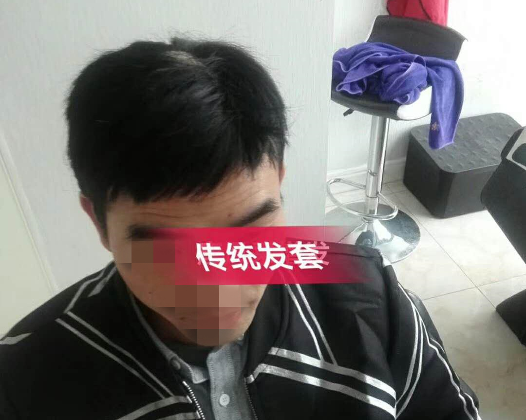 脫發(fā) 開始脫發(fā)的朋友上醫(yī)院,見到專家后他徹底絕望了!