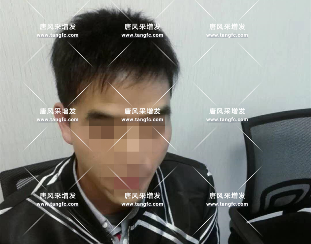 脫發(fā) 開始脫發(fā)的朋友上醫(yī)院,見到專家后他徹底絕望了!