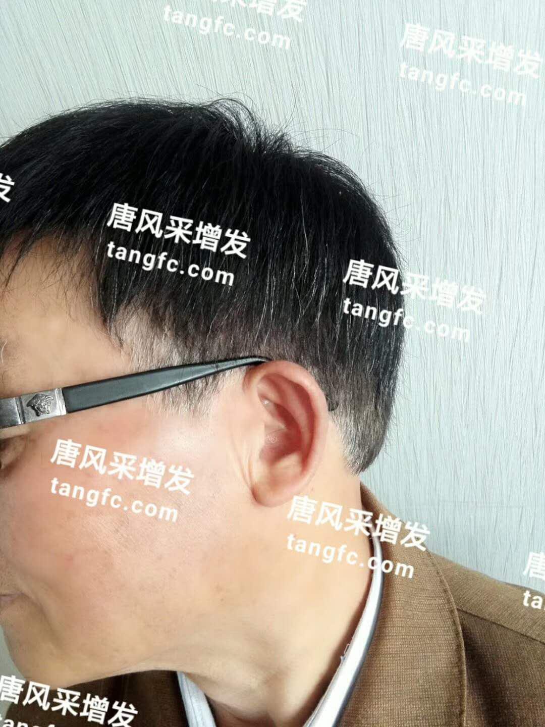脫發(fā) 開始脫發(fā)的朋友上醫(yī)院,見到專家后他徹底絕望了!