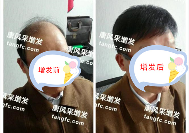 脫發(fā) 開始脫發(fā)的朋友上醫(yī)院,見到專家后他徹底絕望了!