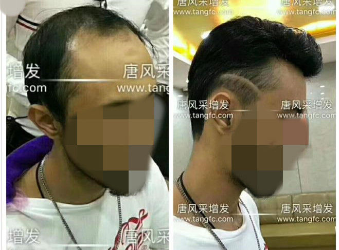 謝頂是顏值也拯救不了的尷尬！