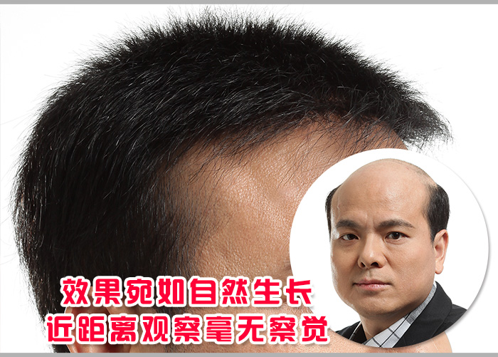 禿頂 別再嘲笑我,我的禿頂已經解決了!