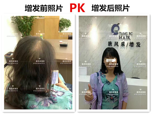 頭發稀少 頭發稀少也能擁有一頭好發型,不信請看!
