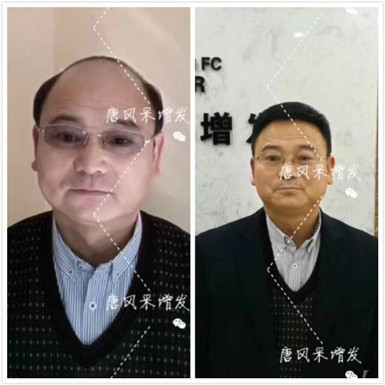 脫發(fā)的中年猥瑣男人 如何避免成為一個脫發(fā)的中年猥瑣男人?