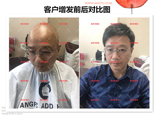 雙節同慶 脫發 雙節同慶,給脫發的父親什么禮物,讓父親“年輕10歲”的神
