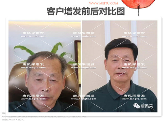 雙節同慶 脫發 雙節同慶,給脫發的父親什么禮物,讓父親“年輕10歲”的神