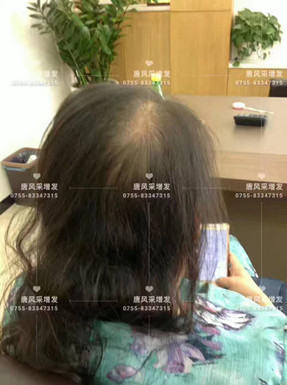 頭發(fā)稀少 頭發(fā)稀少了,我該拿什么來拯救你?