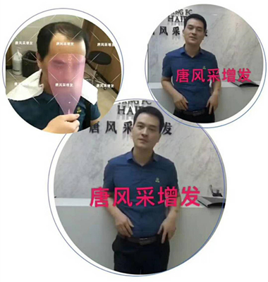 光禿禿 脫發(fā) 光禿禿的院子光禿禿的頭,與其羨慕不如改變!
