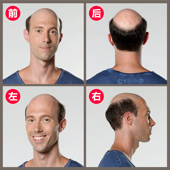 解決脫發(fā) 解決男士脫發(fā)