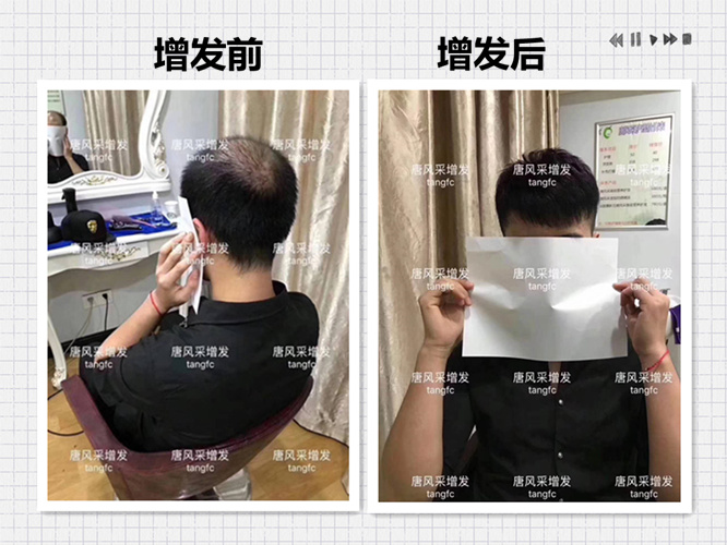 西寧補發哪里好 西寧補發哪里好誰知道? 90后脫發了想做補發!
