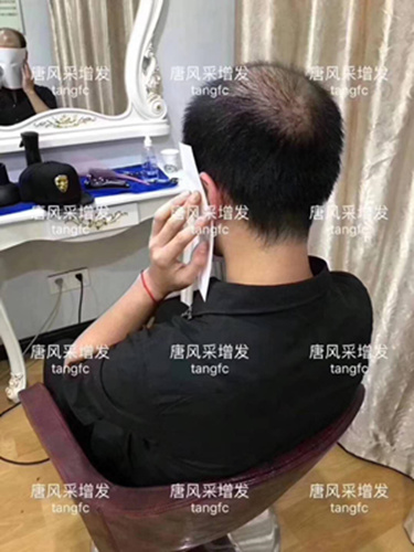 西寧補發哪里好 西寧補發哪里好誰知道? 90后脫發了想做補發!