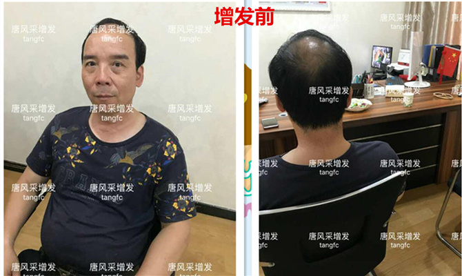 生發密發 如何生發密發?到底有沒有生發奇效的藥物呢?