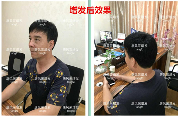 生發密發 如何生發密發?到底有沒有生發奇效的藥物呢?