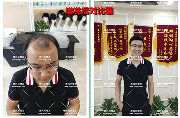 遺傳脫發 他被脫發“啃老”是與遺傳有關啊!