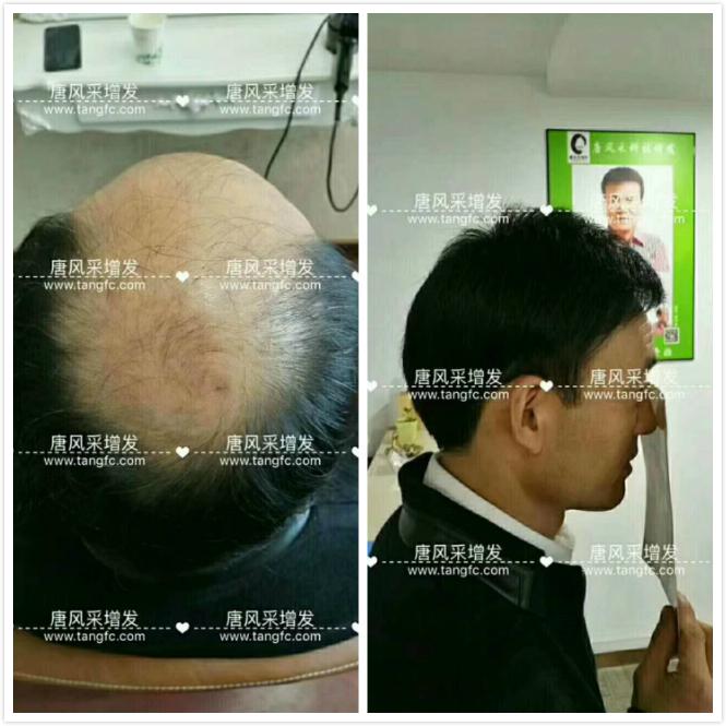 臺州哪里買假發 臺州哪里買假發好,頭發稀疏適合什么樣的假發?