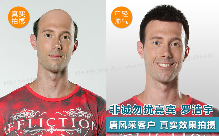 臺州哪里買假發 臺州哪里買假發好,頭發稀疏適合什么樣的假發?