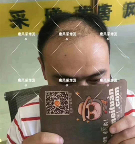 西寧織發補發哪家好，真的能改變我的脫發形象嗎？ 