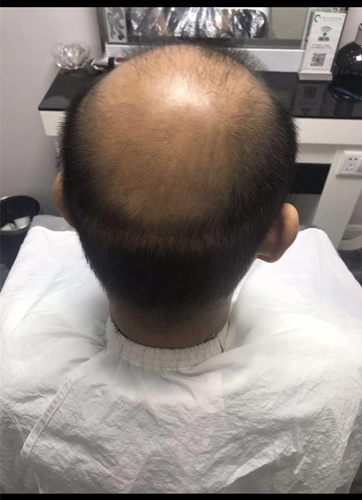 西寧織發補發哪家好，真的能改變我的脫發形象嗎？ 