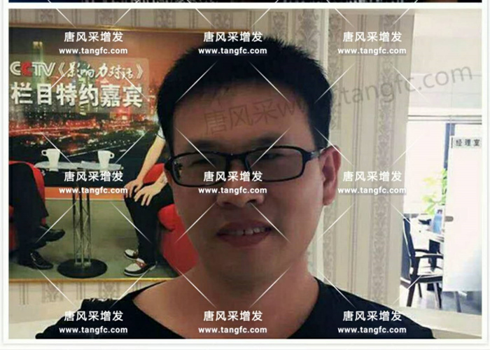 老師，我要你“脫”掉禿頂！
