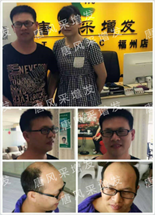 老師，我要你“脫”掉禿頂！