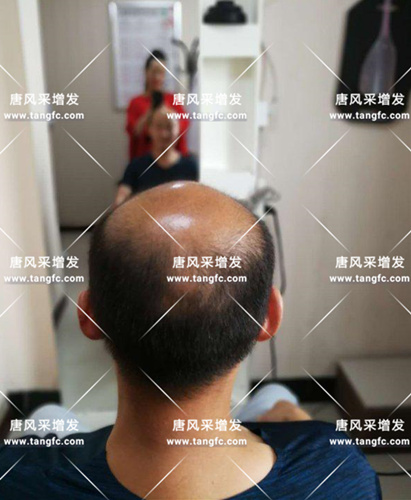 脫發(fā)何棄療? 鄭州店案例趙先生增發(fā)前照片