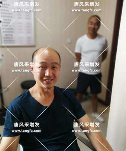 脫發(fā)何棄療? 鄭州店案例趙先生增發(fā)前