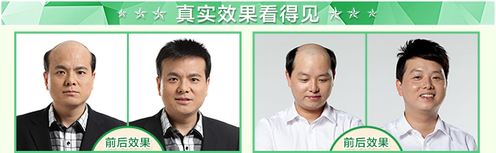西寧哪里有假發專賣店 唐風采增發案例