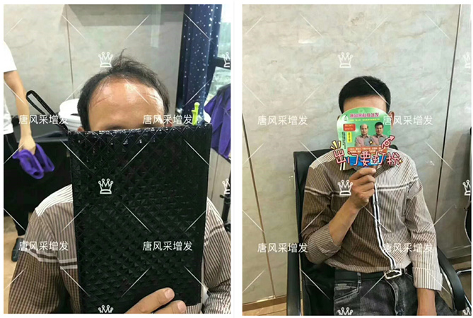男士頭發稀少的原因是什么 唐風采增發客戶案例