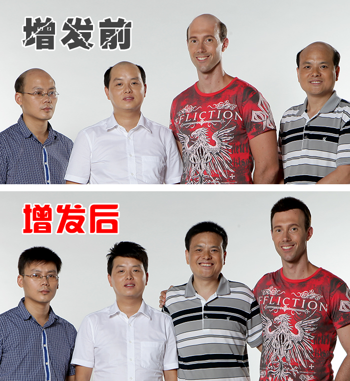 頭發稀少怎么變密,頭發變濃密 唐風采增發案例