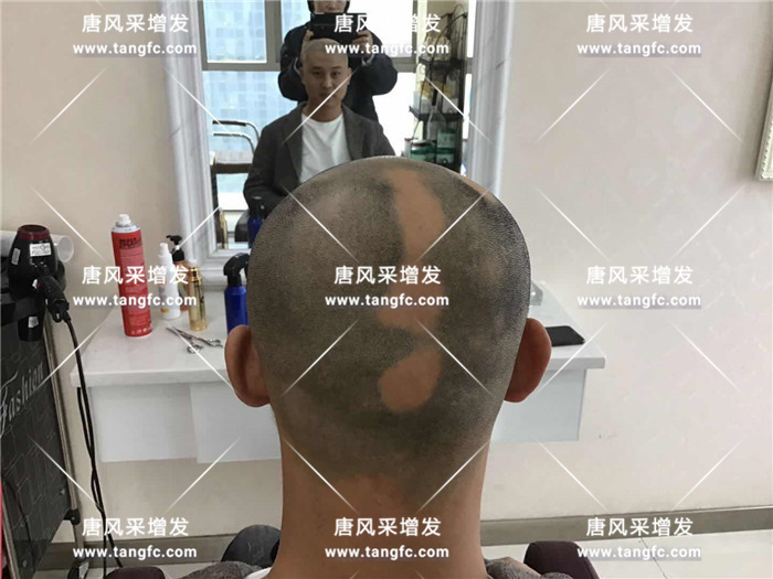 一夜之間形象全毀 趙先生脫發嚴重