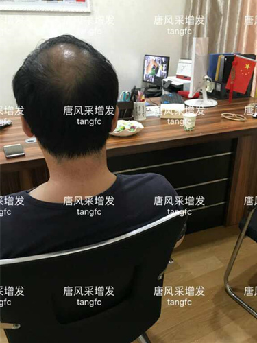 中年禿頂危機 脫發前