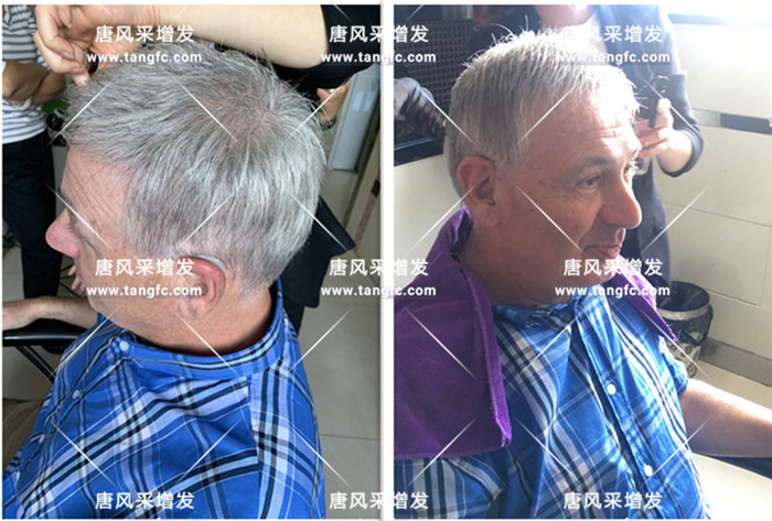 40歲禿頂適合留什么發型, 脫發