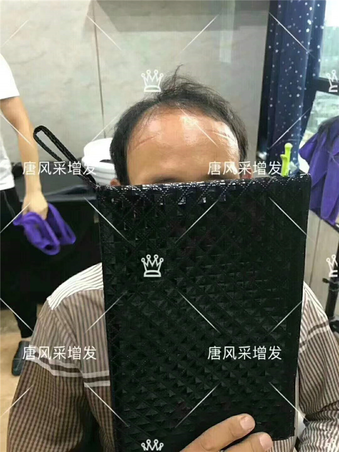 男人有這兩方面變化 雄性激素脫發