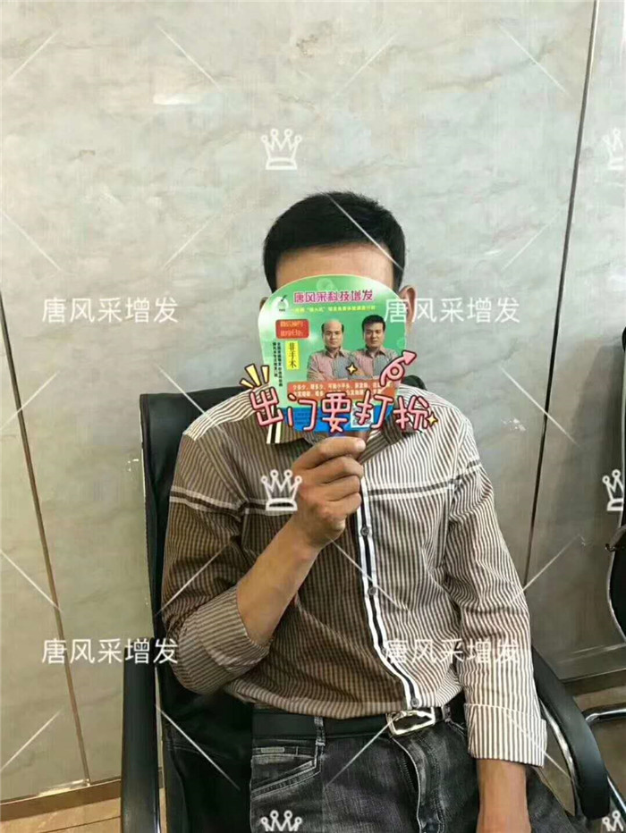 男人有這兩方面變化 雄性激素脫發是不可逆