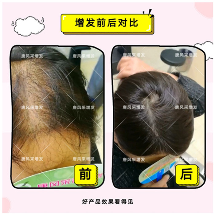 大連補發多少錢 大連補發多少錢?原來頭發也可以這樣補