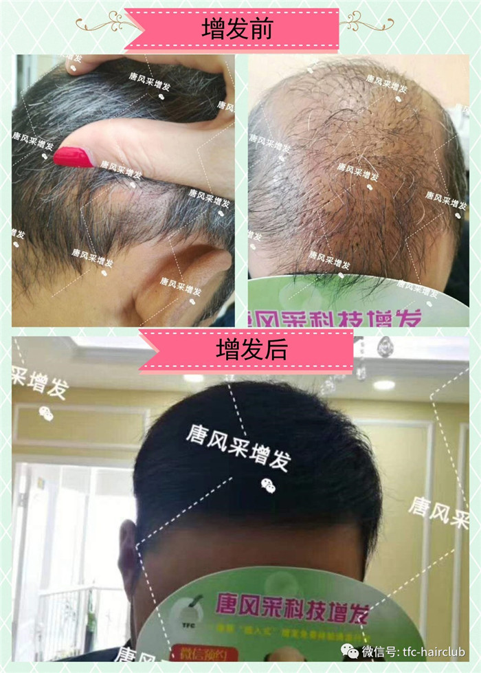 包頭做假發到哪里好 客戶案例