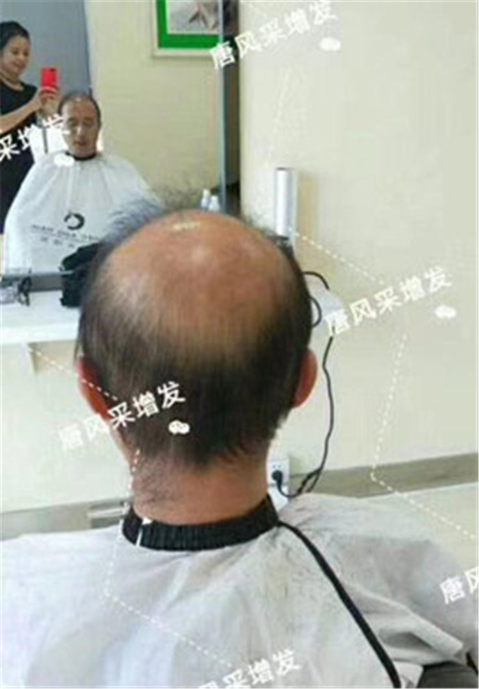 脫發