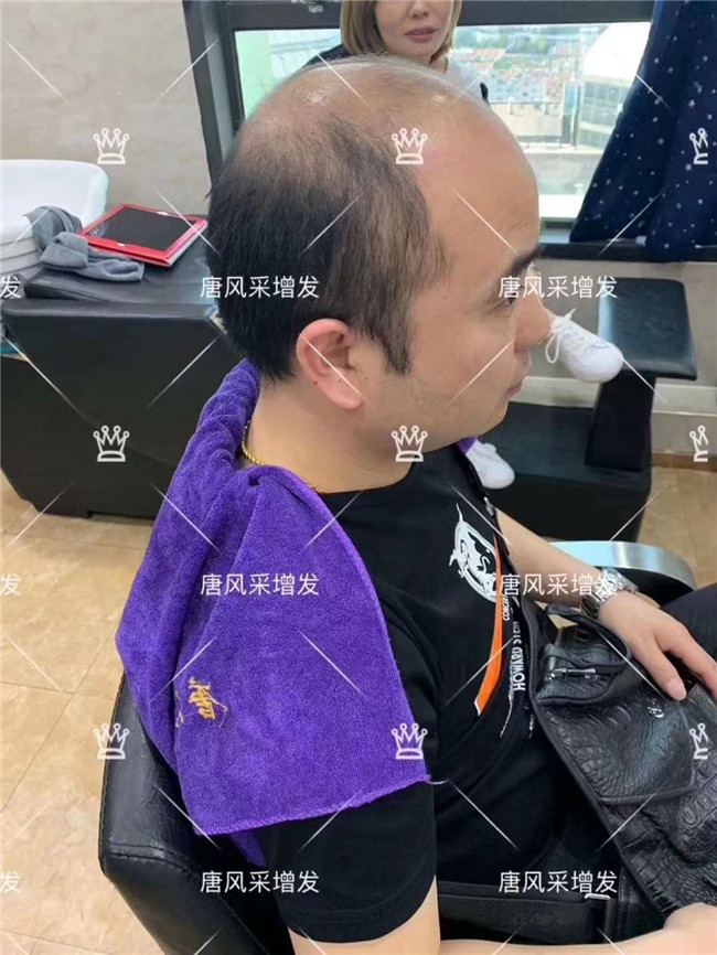 謝頂男人 發量稀少