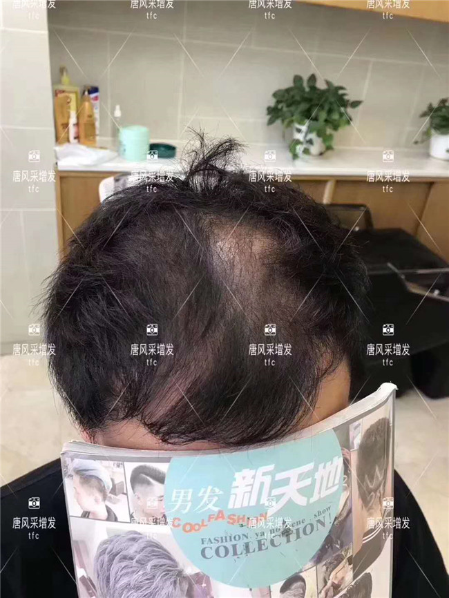 謝頂男人 在唐風采增發后