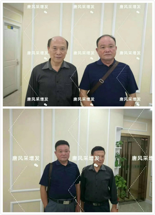 隱形假發
